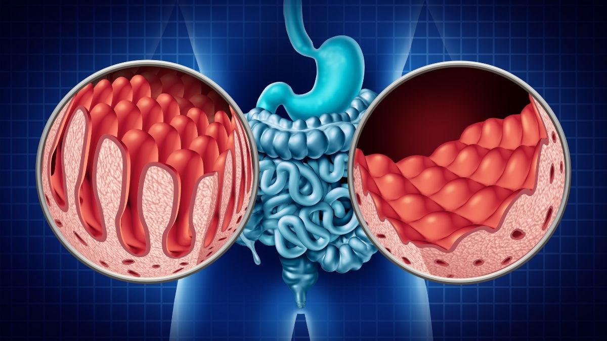 A saúde intestinal pode ser regulada com fibras?